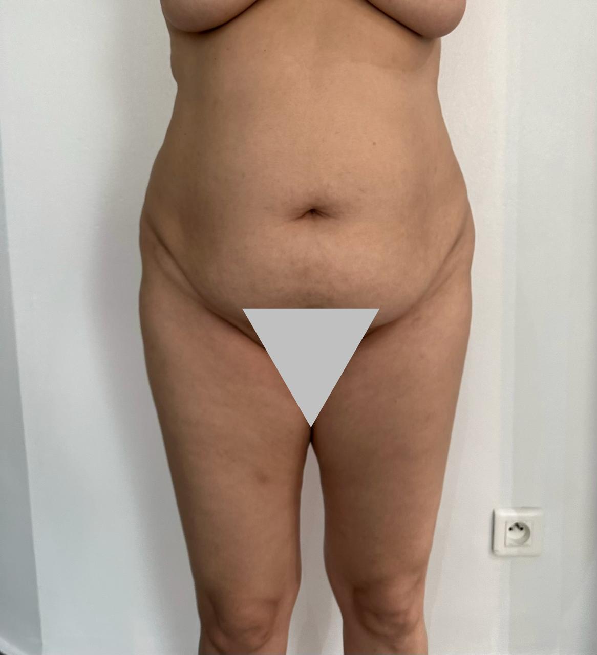 Avant — Abdominoplastie — résultat en vidéo