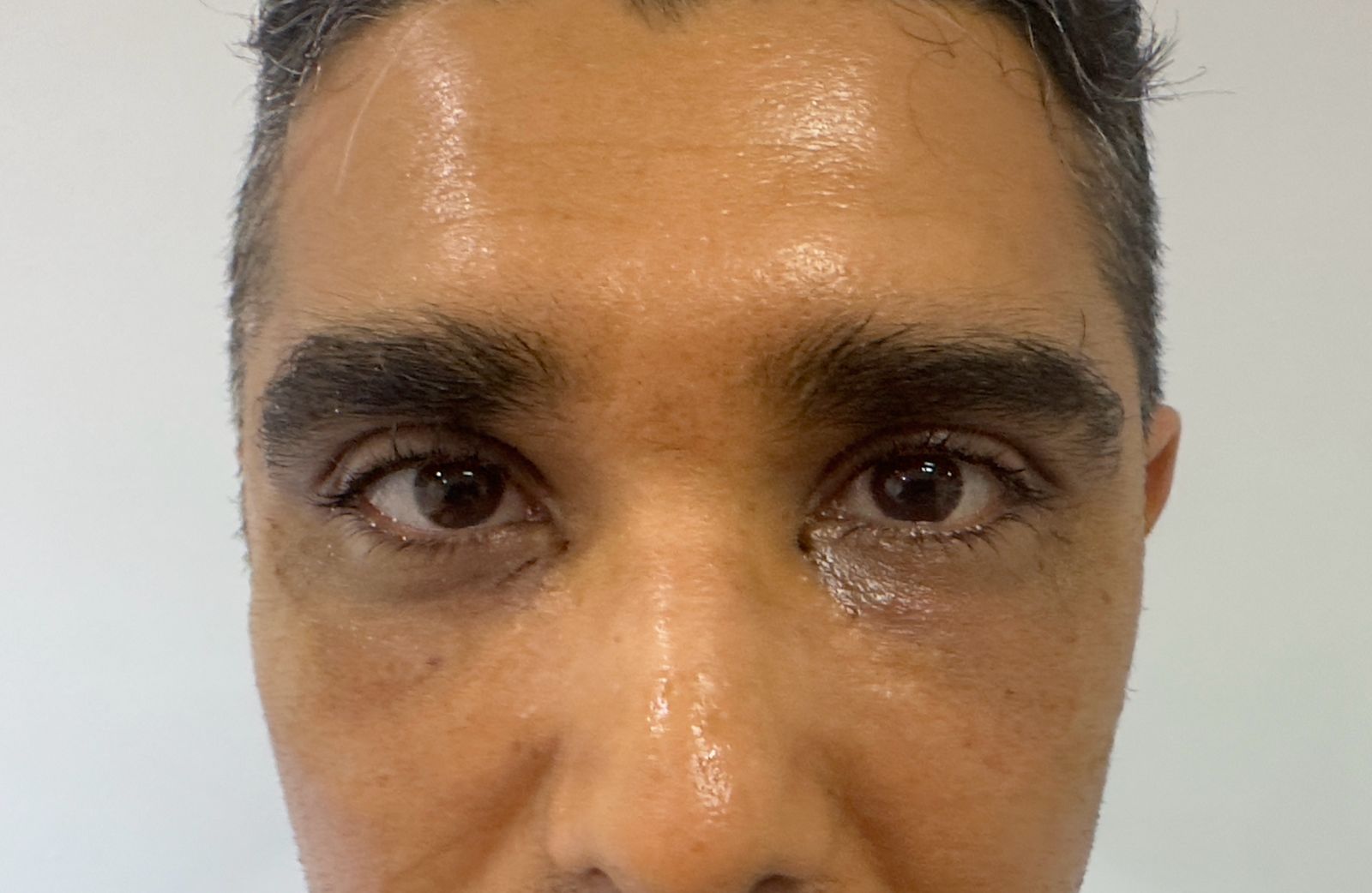 Après — Blépharoplastie