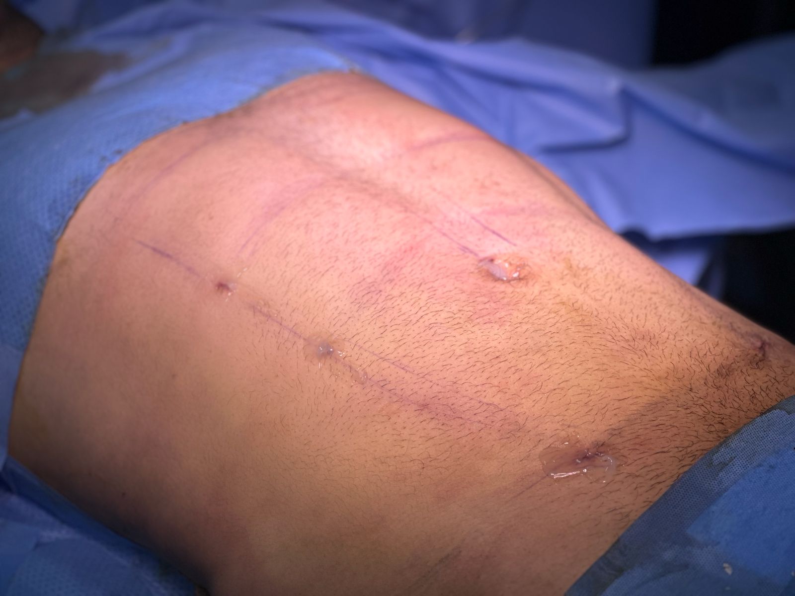 Après — Liposuccion Haute Définition